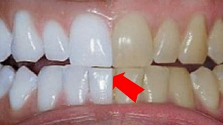 dentes