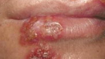 herpes