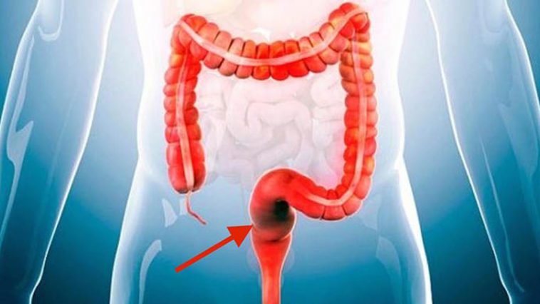 cancro_colon