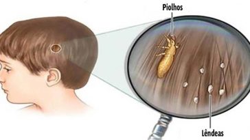 piolhos_criancas