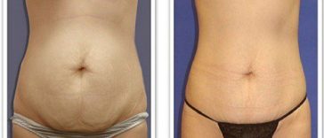 barriga_lisa