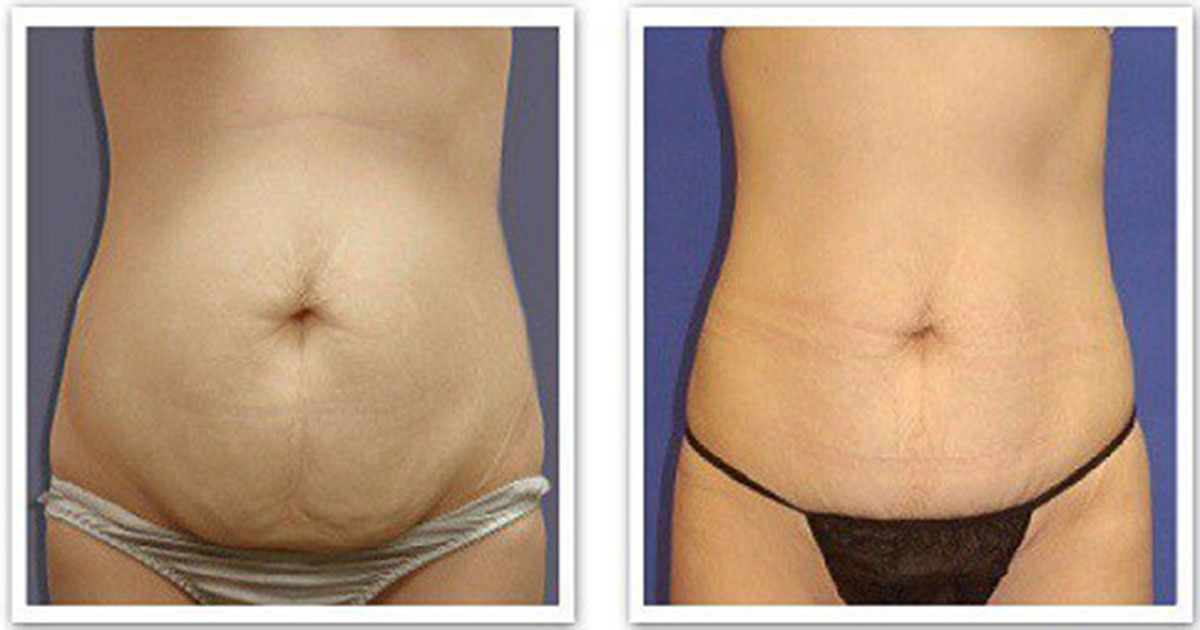 barriga_lisa